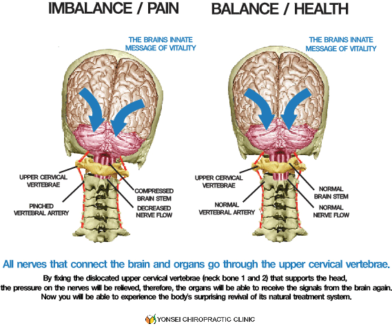 Illustration of car accident impact and whiplash