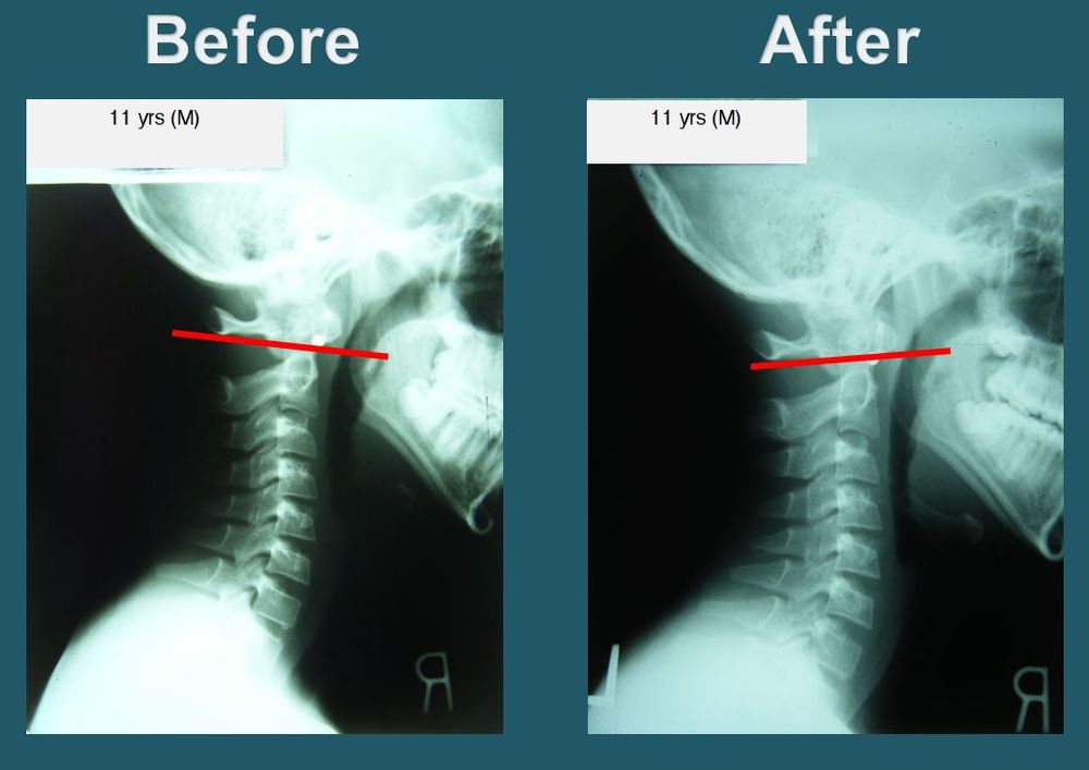 After-treatment front and side spinal X-ray images documenting post-care posture