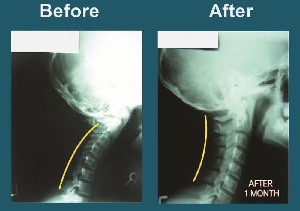 Follow-up cervical spine X-ray used to track continued progress after treatment