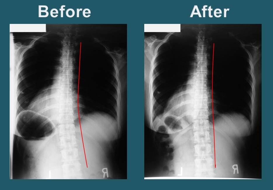 Before-treatment side-view cervical X-ray used for upper cervical evaluation